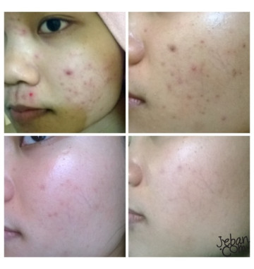 Гель от шрамов, рубцов и постакне Clenascar 7 или 15 гр